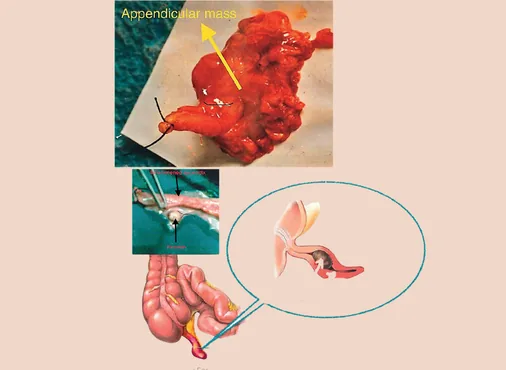 Appendicular Mass consultation at Niraaya Hospital